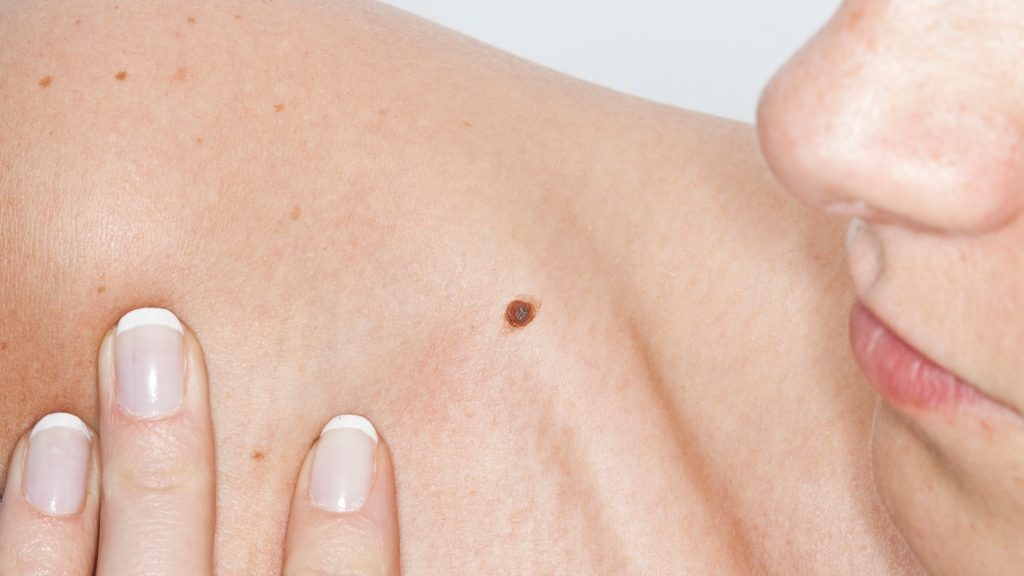 Los lunares peligrosos: cómo reconocerlos y tratarlos para evitar un posible cáncer a la piel
