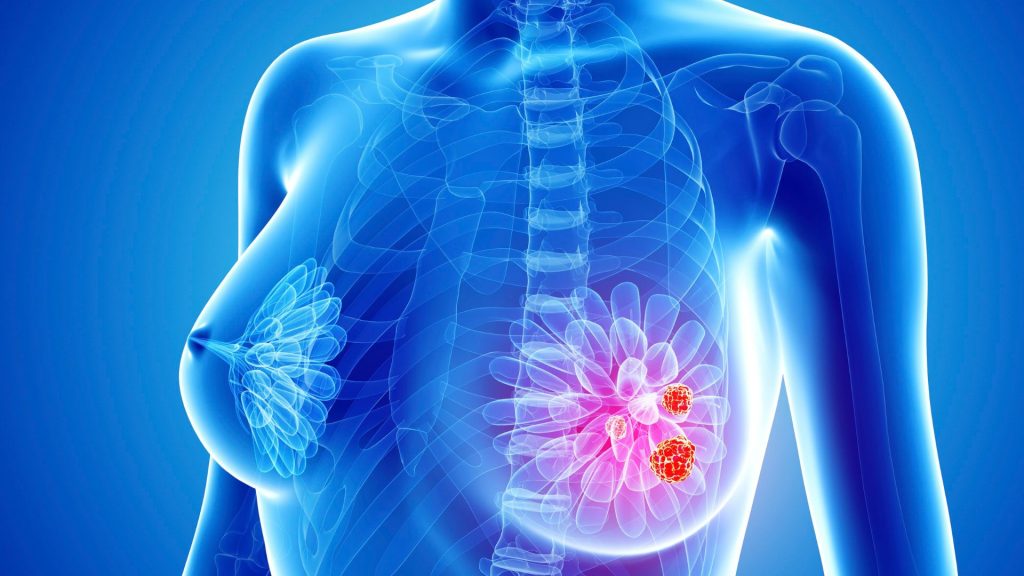 Inteligencia artificial puede detectar cáncer de mama con cuatro años de anticipación